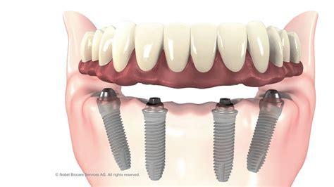 All on 4全口植牙